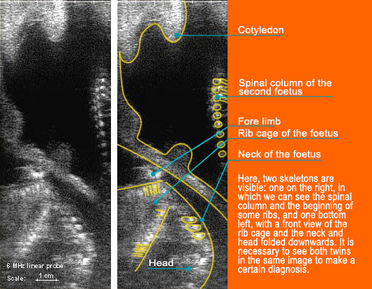 Pregnancy Scanning