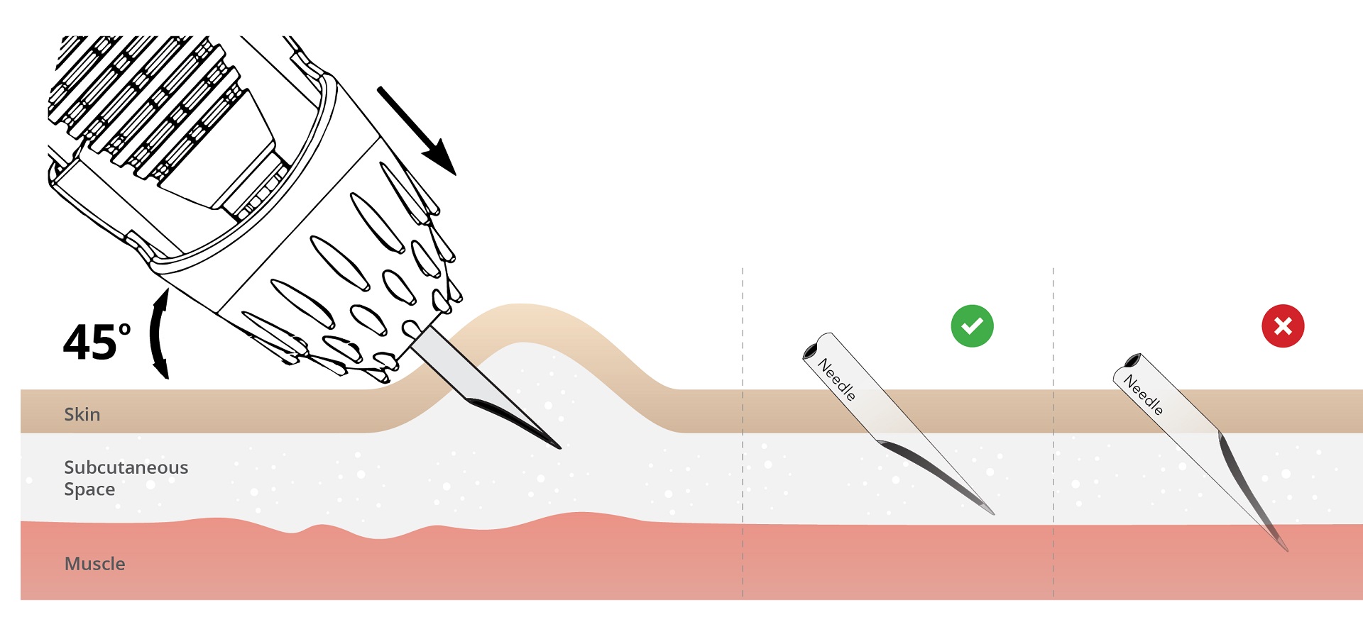 Correct vaccination angle